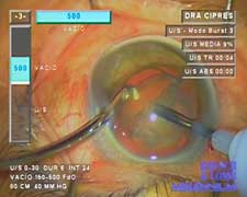 Strong holding force and a stable anterior chamber