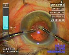 The final aspiration is easy, and the corneal incision at the end is clear