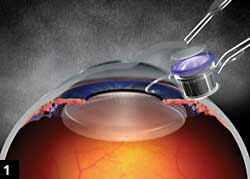 Figure 1: Implantable Miniature Telescope being implanted