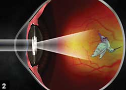 Figure 2: Illustration  depicting the Lipshitz Macular Implant