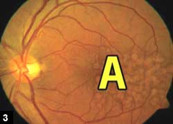 Figure 3: The IOL magnifies the central image on the retina