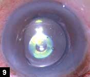 Figure 9: LMI being implanted after the posterior chamber IOL was explanted