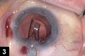 Figure 3: The lens is uniplanar and does not require cartridge or injector rotation once in the incision