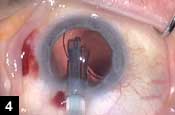 Figure 4: The piston can be used as a surgical instrument to manipulate the lens inside the eye