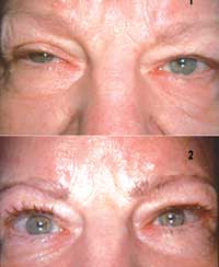 A patient before (top) and after minimal ptosis surgery