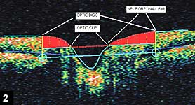 Figure 2: Optic nerve head scan