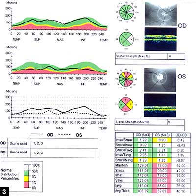 Figure 3: RNFL analysis