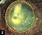 Figure 2: The colored rings show the displacement of the lens and elongation of the ciliary processes during nucleus maneuvers