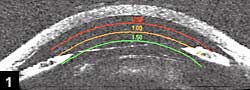 Figure 1: Posterior chamber Visian ICL implant