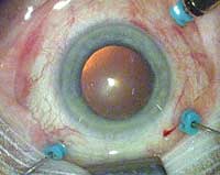 In this 25-gauge vitrectomy technique no sub-Tenon injection is used