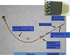 The subretinal implant for the clinical pilot study