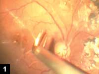 Figure 1: Epiretinal macular membrane is surgically removed