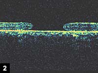 Figure 2: The various stages of a macular hole can be identified on OCT