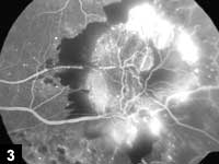 Figure 3: Neovascularization on the retina as seen on FFA