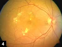 Figure 4: Diabetic retinopathy