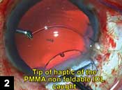 Figure 2: Tip of haptic of the PMMA non-foldable IOL caught