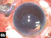 Figure 6b: Haptics are externalized under the scleral flaps, and the IOL is well-centered