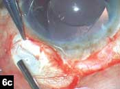 Figure 6c: Fibrin glue applied and scleral flaps seal the haptic of the IOL