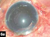 Figure 6e. Fibrin glue seals the conjunctiva