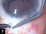 Figure 7. IOL haptic tucked through a scleral tunnel