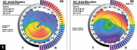 Figure 1: Curvature (left) and elevation (right) maps for a keratoconic cornea are noticeably different