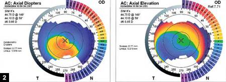 Figure 2: Axial (left) and elevation (right) maps for a patient with a decentered ablation