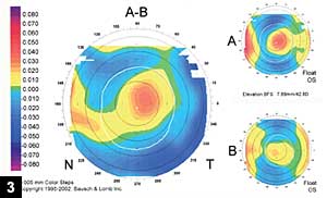 Figure 3: The elevation map before hyperopic LASIK and after hyperopic LASIK, with the difference map showing the induced change