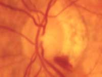 Flame-shaped hemorrhages on the optic nerve head