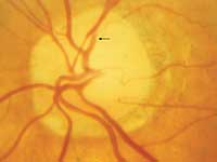 Localized constrictions of retinal arteries in the vicinity of the optic nerve