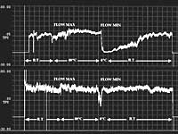 Studies in vasospastic patients and nonvasospastic patients highlight that blood flow in the neuroretinal rim is more sensitive to changes in IOP in vasospastic patients