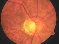 Studies in vasospastic patients and nonvasospastic patients highlight that blood flow in the neuroretinal rim is more sensitive to changes in IOP in vasospastic patients