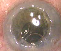 Femtosecond laser-assisted corneal grafting using decagonal-shaped cut