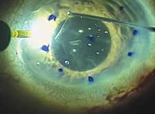 Sclerotic scattering-like illumination from the sclerocorneal margin