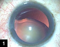 Figure 1: Colobomatous lens