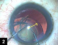 Figure 2: Endocapsular ring implantation