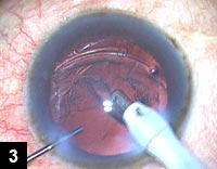 Figure 3: Cortical aspiration in eye with lens coloboma