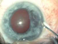 Injection of suprarenin does not dilate the pupil but shows the floppy appearance of the iris