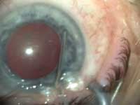 Injection of 2.3% sodium hyaluronate dilates the pupil, allowing for a normal capsulorrhexis