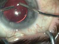 Careful removal of the OVD is mandatory at the end of surgery