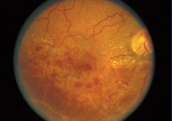 Figure 1a. Posurdex study. Fundus photos shown at baseline 20/160 (left) and at 90 days 20/32 (right).