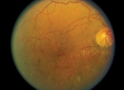 Figure 1b. Posurdex study. Fundus photos shown at baseline 20/160 (left) and at 90 days 20/32 (right).