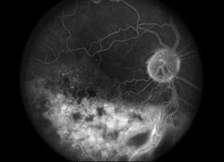 Figure 2a. Posurdex study. Angiographic leakage (left), improvement at 3 months (right).