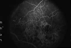 Figure 2b. Posurdex study. Angiographic leakage (left), improvement at 3 months (right).