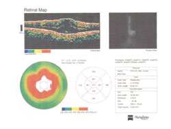 Figure 3a. Posurdex study. OCT at baseline (left) and improvement at 3 months (right).