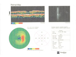 Figure 3b. Posurdex study. OCT at baseline (left) and improvement at 3 months (right).