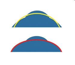 Figure 1. By incorporating the abnormal portion of the cornea (cone), the resultant BFS is steeper and the elevation difference between the BFS and the cone is less (top). 