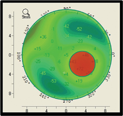 Figure 2. The map shows the exclusion zone in red, which is a 3.5-mm circular area centered on the thinnest portion of the cornea. 