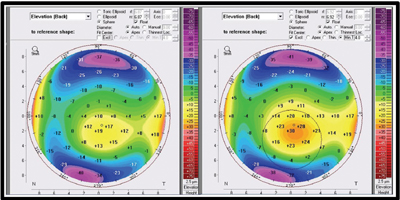 Figure 3. Posterior elevation map of a conical cornea shows excluding the 3.5-mm zone from the BFS calculation eliminates the cone or steep portion and results in a significantly flatter BFS.