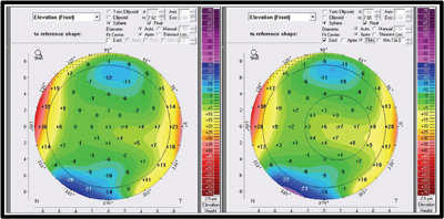 Figure 4. Anterior elevation map of a normal cornea shows how excluding the 3.5-mm zone from the BFS in this normal eye has little effect on the BFS computation. 