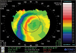 Corneal topography shows decentered